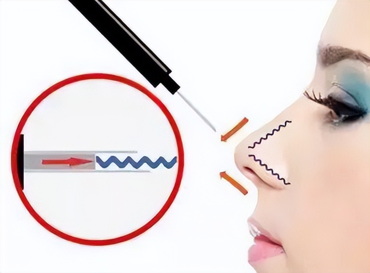 市面上有哪些隆鼻方式,现在的隆鼻技术都是做的微创吗