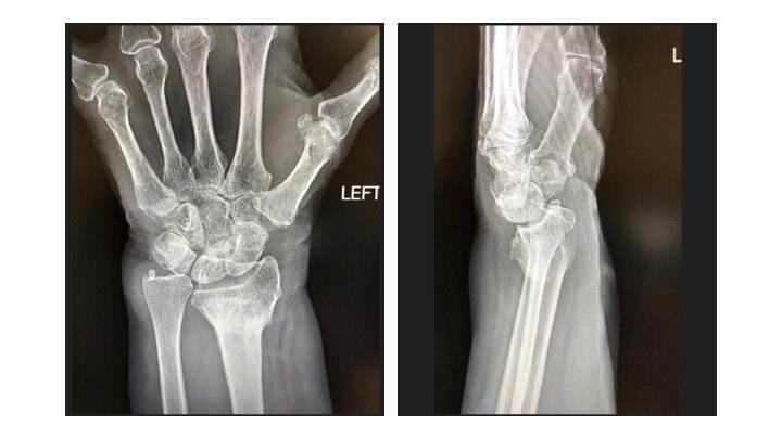 骨骼一碰就碎是什么病,骨骼一碰就碎