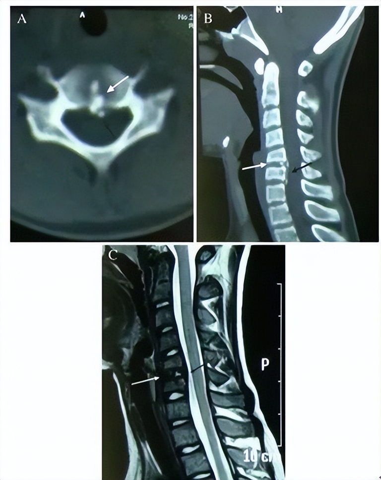 颈椎常见病变图片,颈椎严重的病例