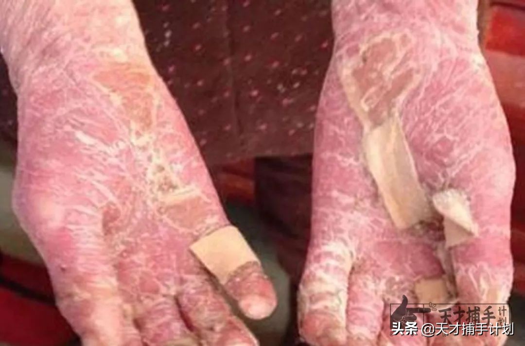 临床罕见病真实病例记录,超4成罕见病患者经历过误诊