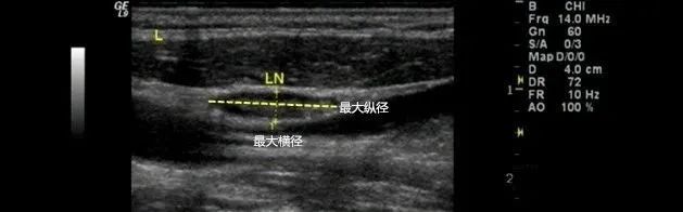 小孩脖子淋巴结有疙瘩一直存在,淋巴结发炎脖子上有疙瘩怎么办