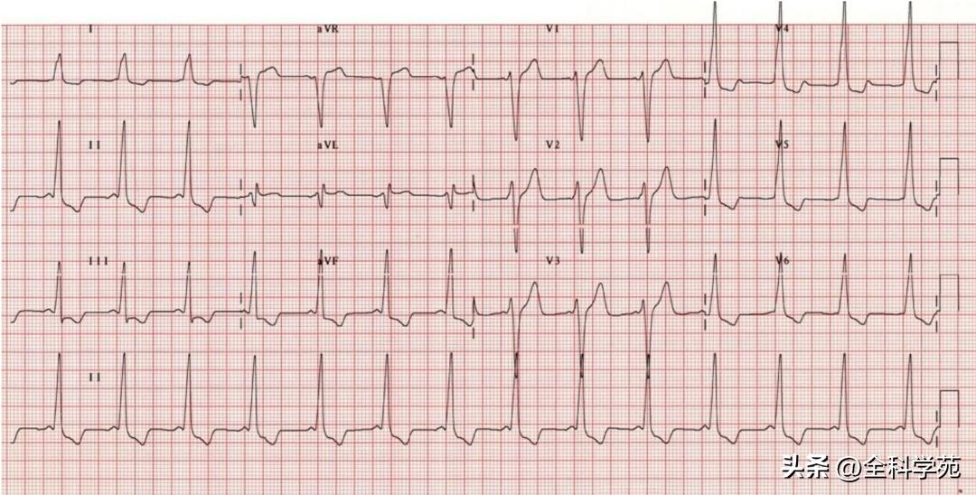t波倒置三种常见原因,t波低平倒置有事吗