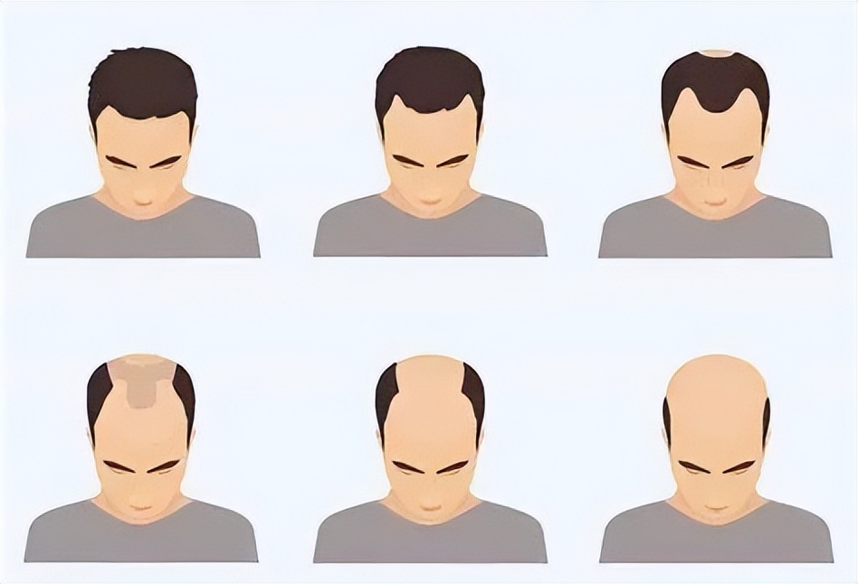 脱发生活真是太让人头秃了,四个脱发坏习惯不想变秃就不要做