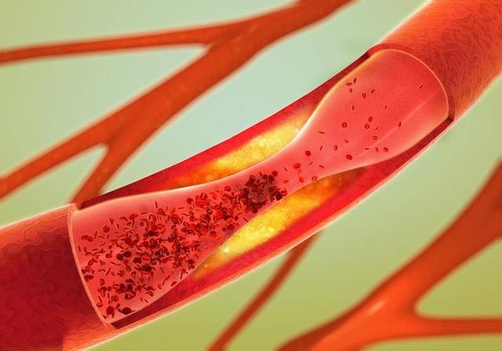 高血压冠心病颈动脉斑块吃什么药,冠心病消除斑块的中药方子