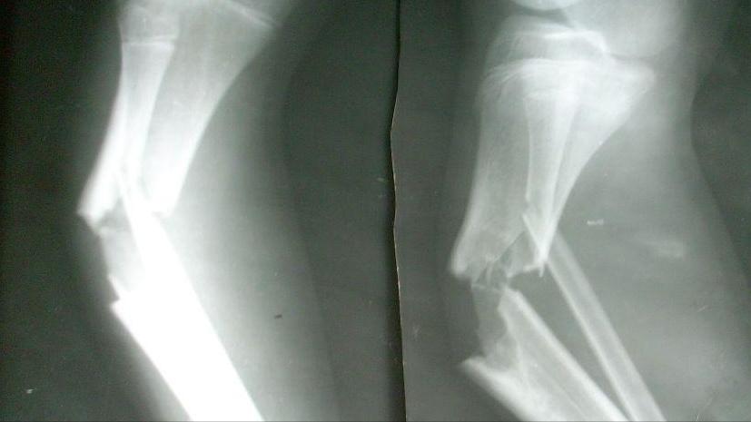 有癌腰痛是什么症状,体内有癌腰部先知