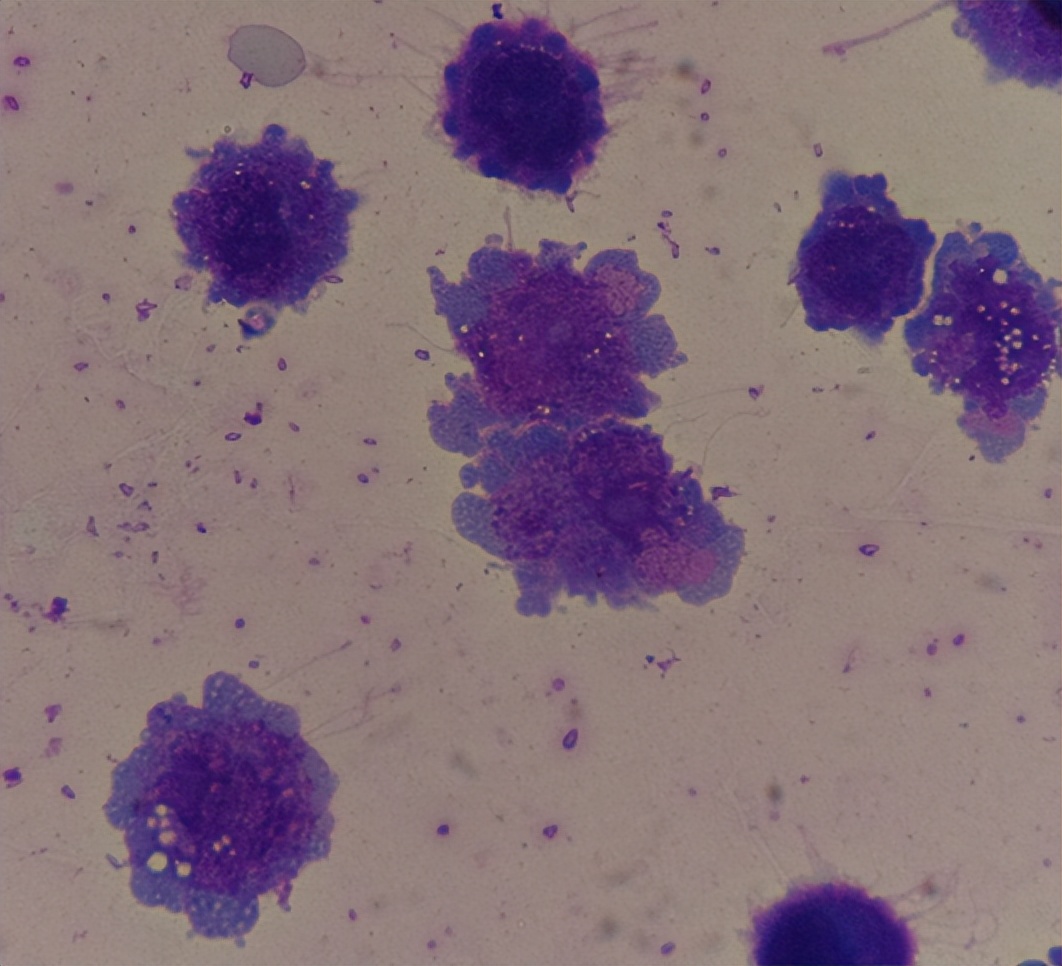 脑膜炎10天才确诊,脑膜炎确诊