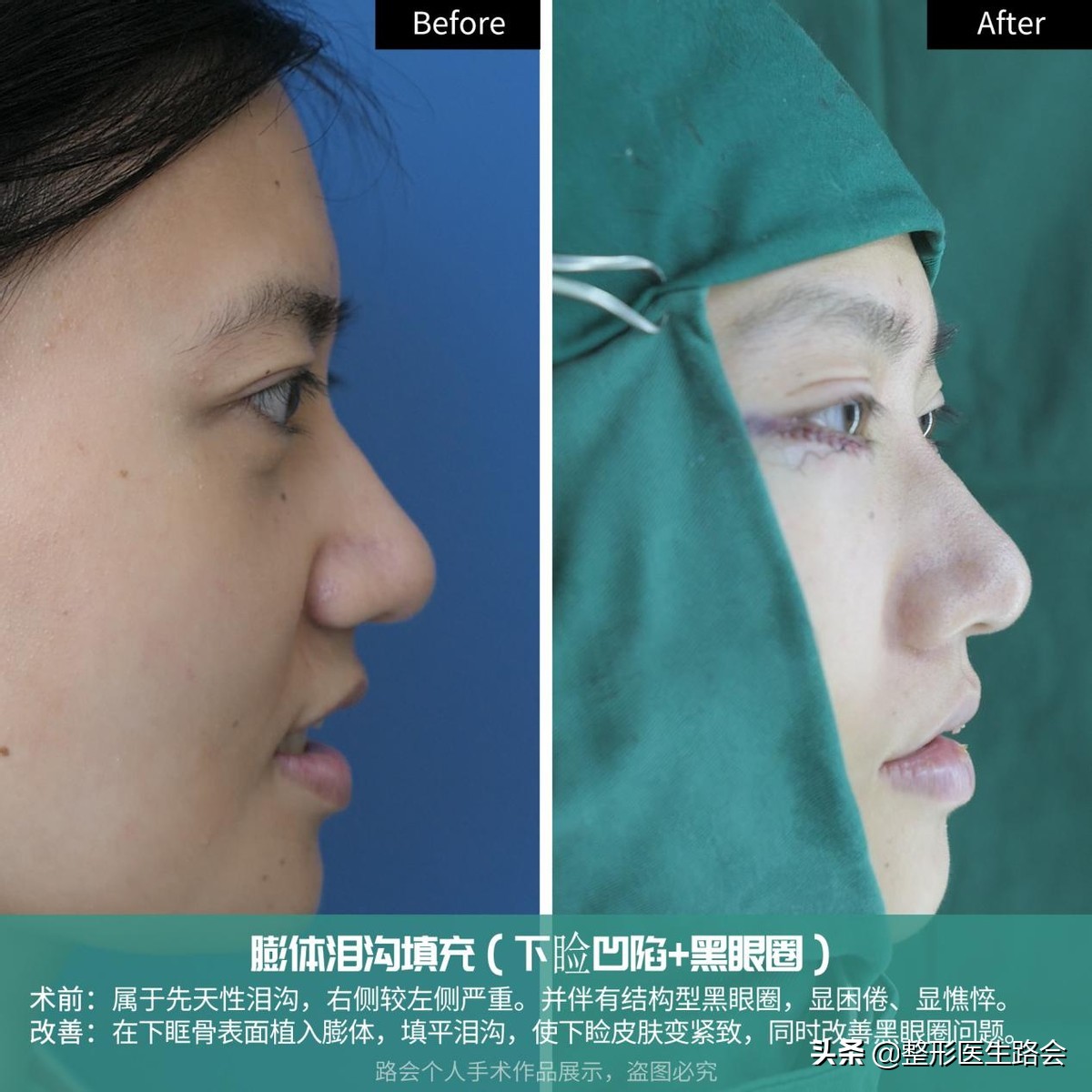 29岁眼袋黑眼圈泪沟严重怎么处理,35岁做泪沟眼袋最好的方法