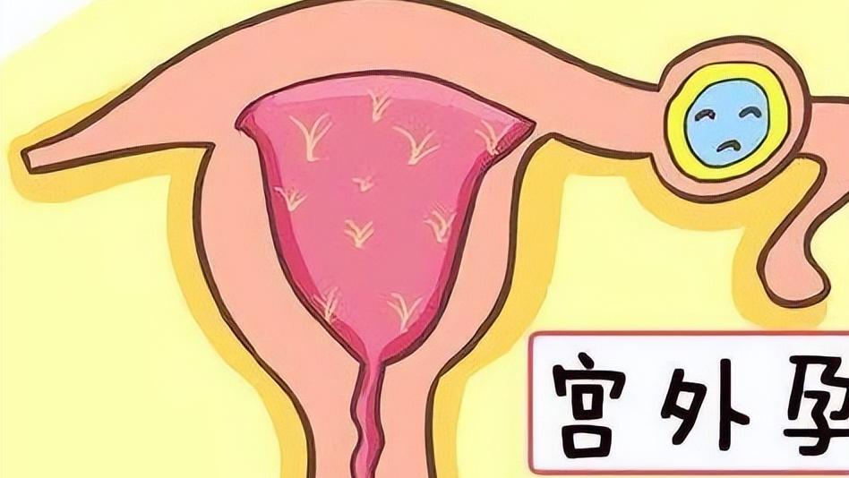 宫外孕都是有什么状况,宫外孕是怎么回事严重吗