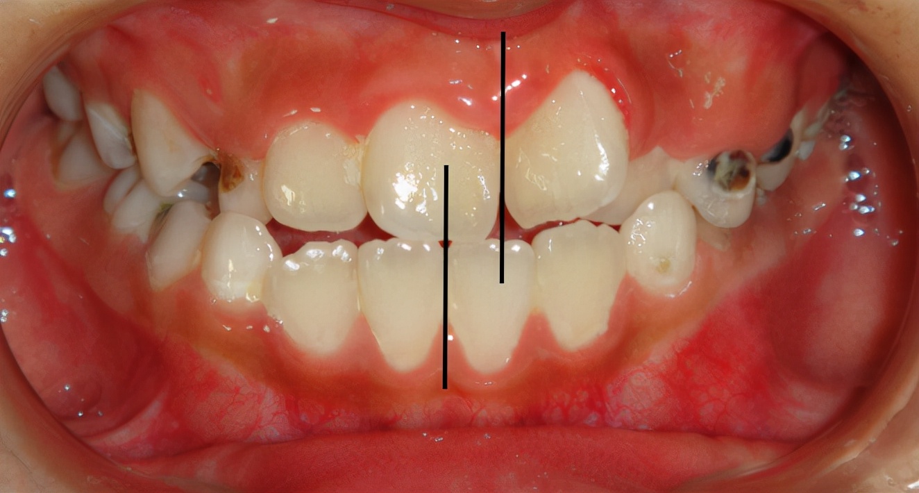 徐州儿童牙齿矫正牙齿不齐,大连口腔医院儿童牙齿矫正怎么样