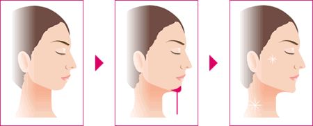 隆下巴用什么材料好,隆下巴什么材料做假体