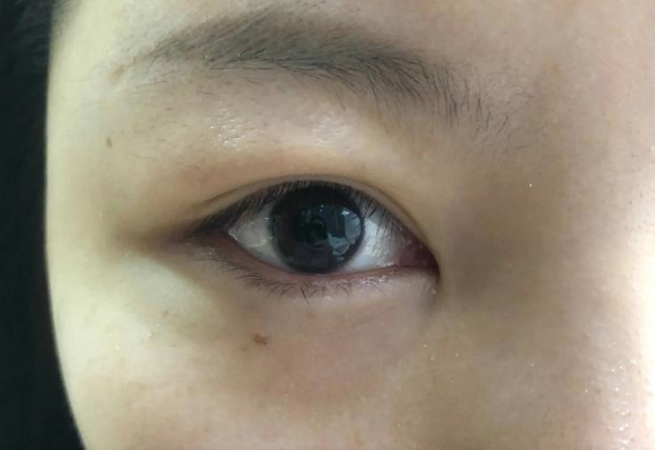 双眼皮做什么术式的好,微创双眼皮术式