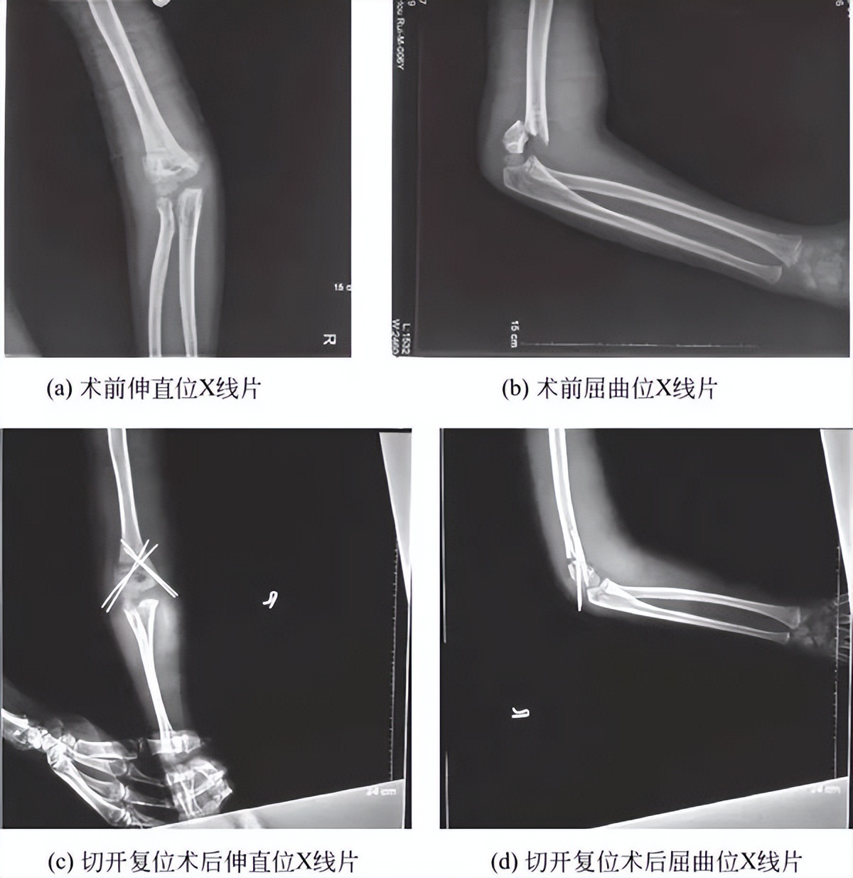 跟骨骨折和肱骨骨折哪个严重,儿童肱骨髁上骨折最常见并发症
