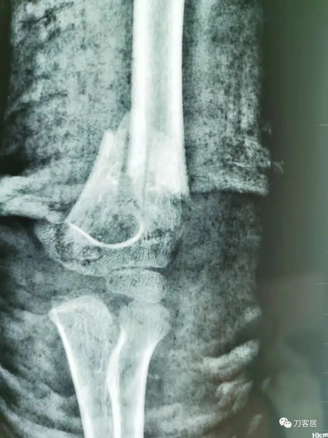 孩子胳膊摔伤肿了不能弯曲一直疼,9岁男孩摔倒手臂痛怎么办