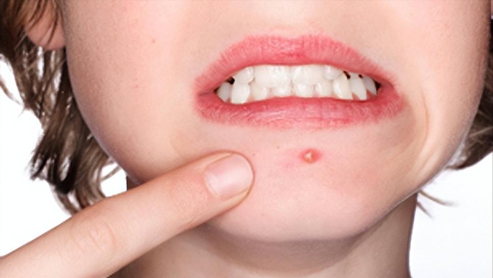 青春期面上长疮该吃什么,青春期顽固痤疮怎么样治疗才能好