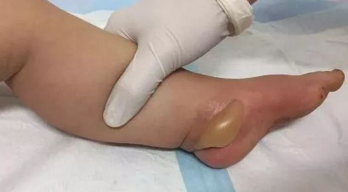 如果孩子被烫伤怎么正确处理,小孩被开水烫伤怎么处理好