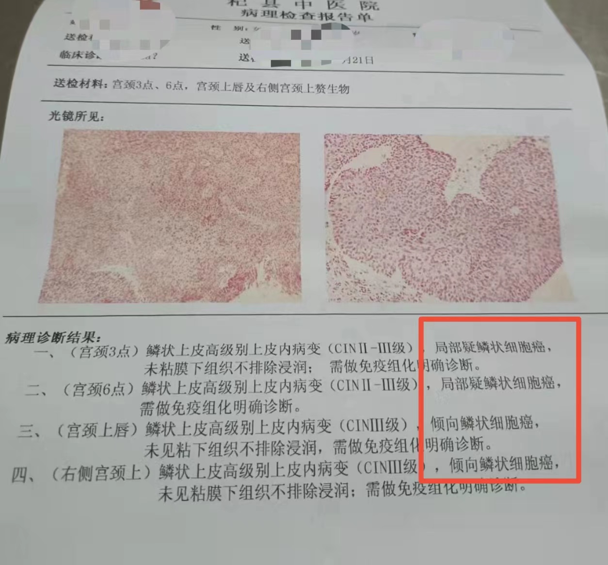 宫颈癌的4个常识,宫颈癌很可怕三个步骤教你预防