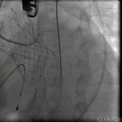 病例回顾与分享,腹膜后血肿介入治疗