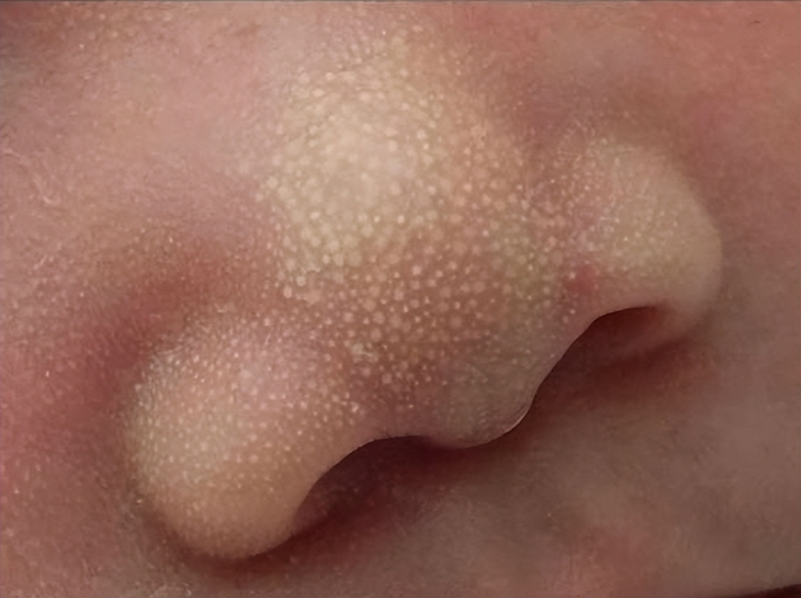 婴儿一激动就打嗝咋回事,胃胀打嗝放屁多体重下降