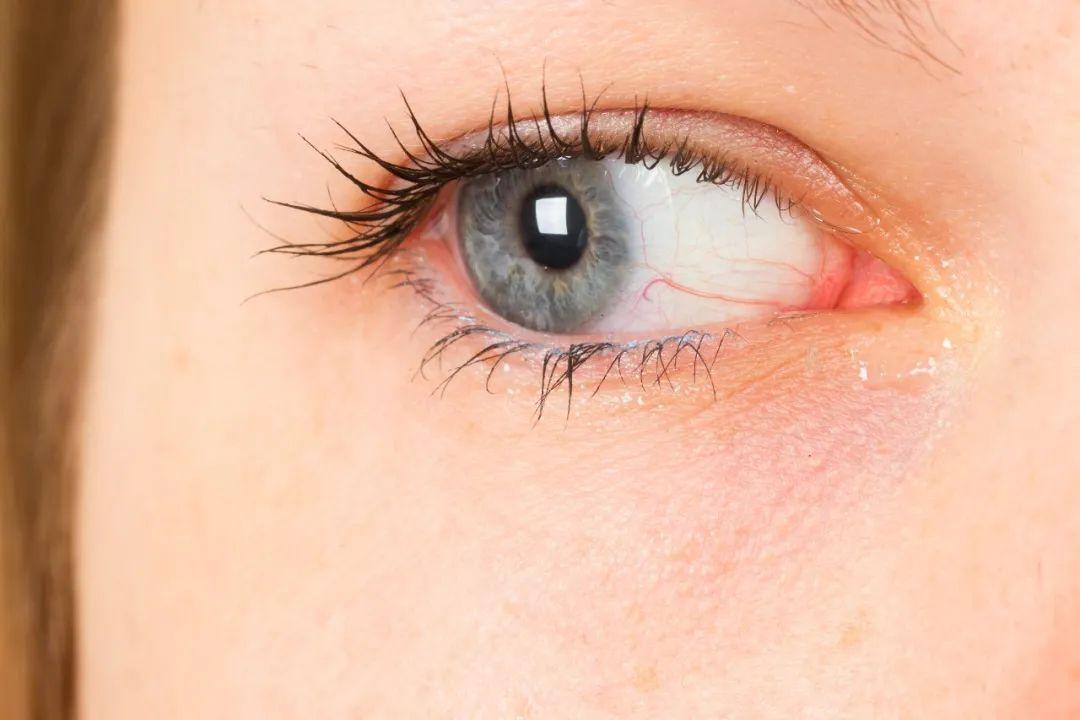 斜视戴眼镜可以矫正过来吗,3-6岁幼儿斜视矫正训练