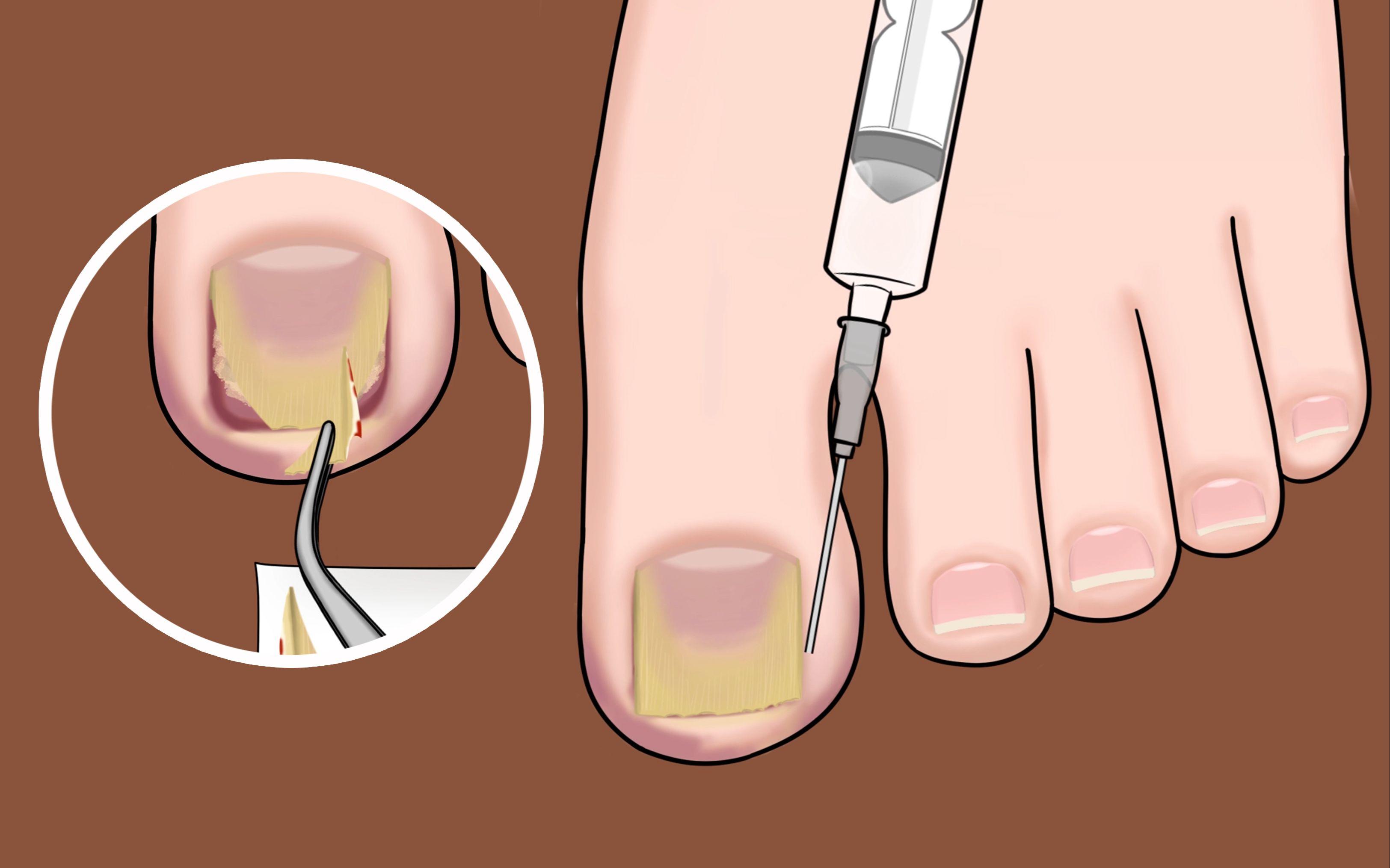 指甲往肉里长怎么办,指甲老往肉里钻