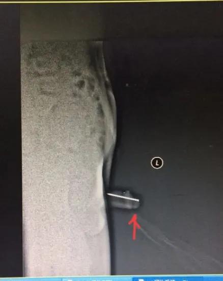 男孩往尿道塞近200颗“玩具球”，喜欢塞东西的熊孩子怎么回事