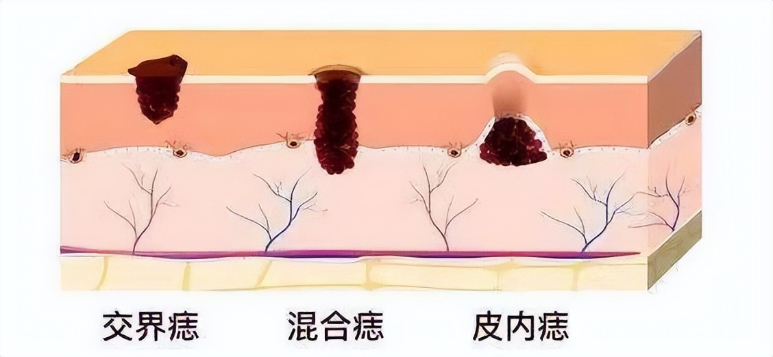 人各有“痣”，长在这些部位的痣易癌变！ABCDE法自测危险程度