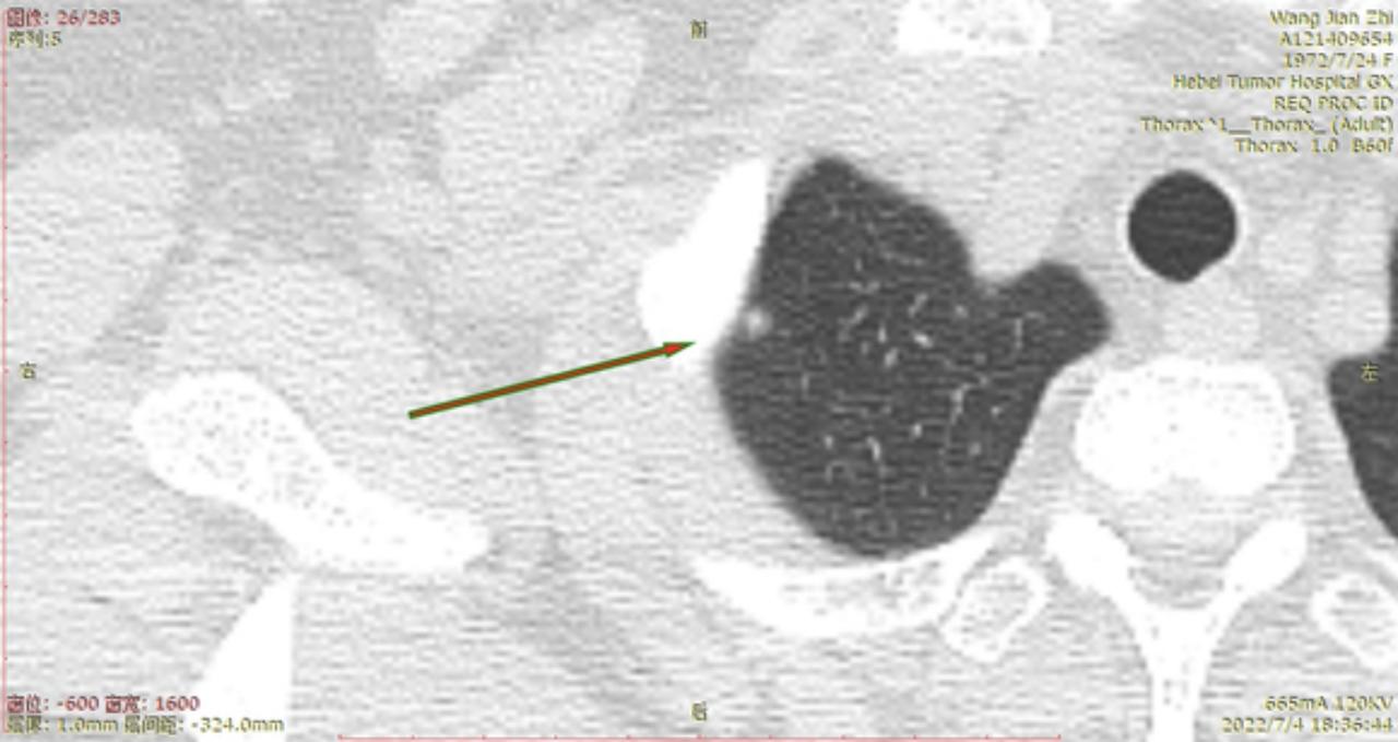 首次发现磨玻璃结节要吃药消炎吗,磨玻璃结节警惕合并占位