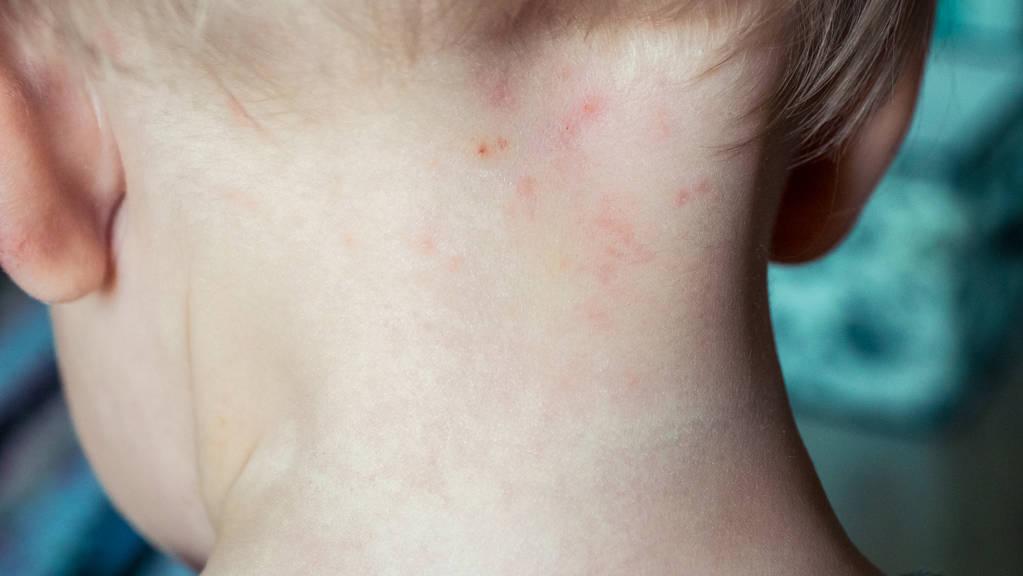 湿疹痱子严重怎么办,湿疹痱子傻傻分不清