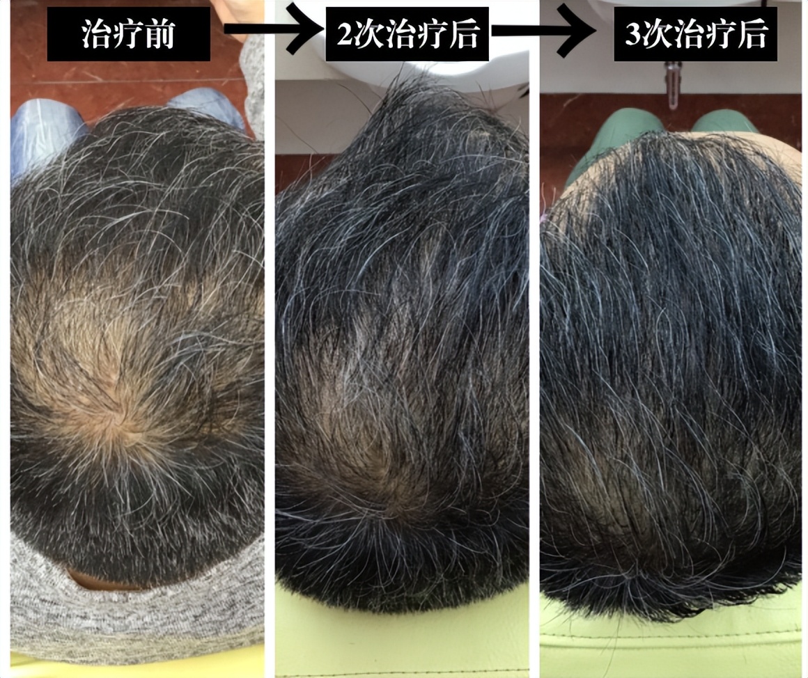 脱发根本就不能治,脱发治不了的视频