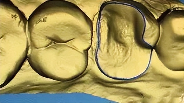 补牙跟嵌体有什么区别哪个更牢固,补牙为什么非要根管