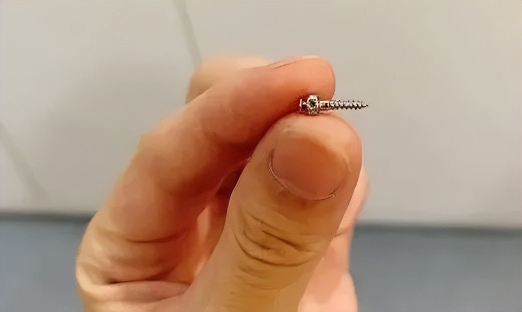 整牙亲身经历分享一下,整牙的经历分享