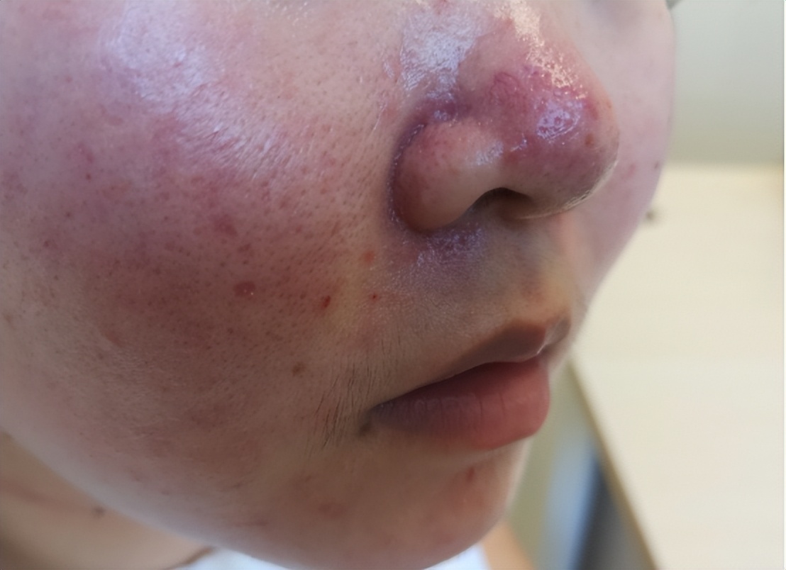 脸部皮肤破了可以刷酸吗,面部刷酸灼伤皮肤怎么恢复