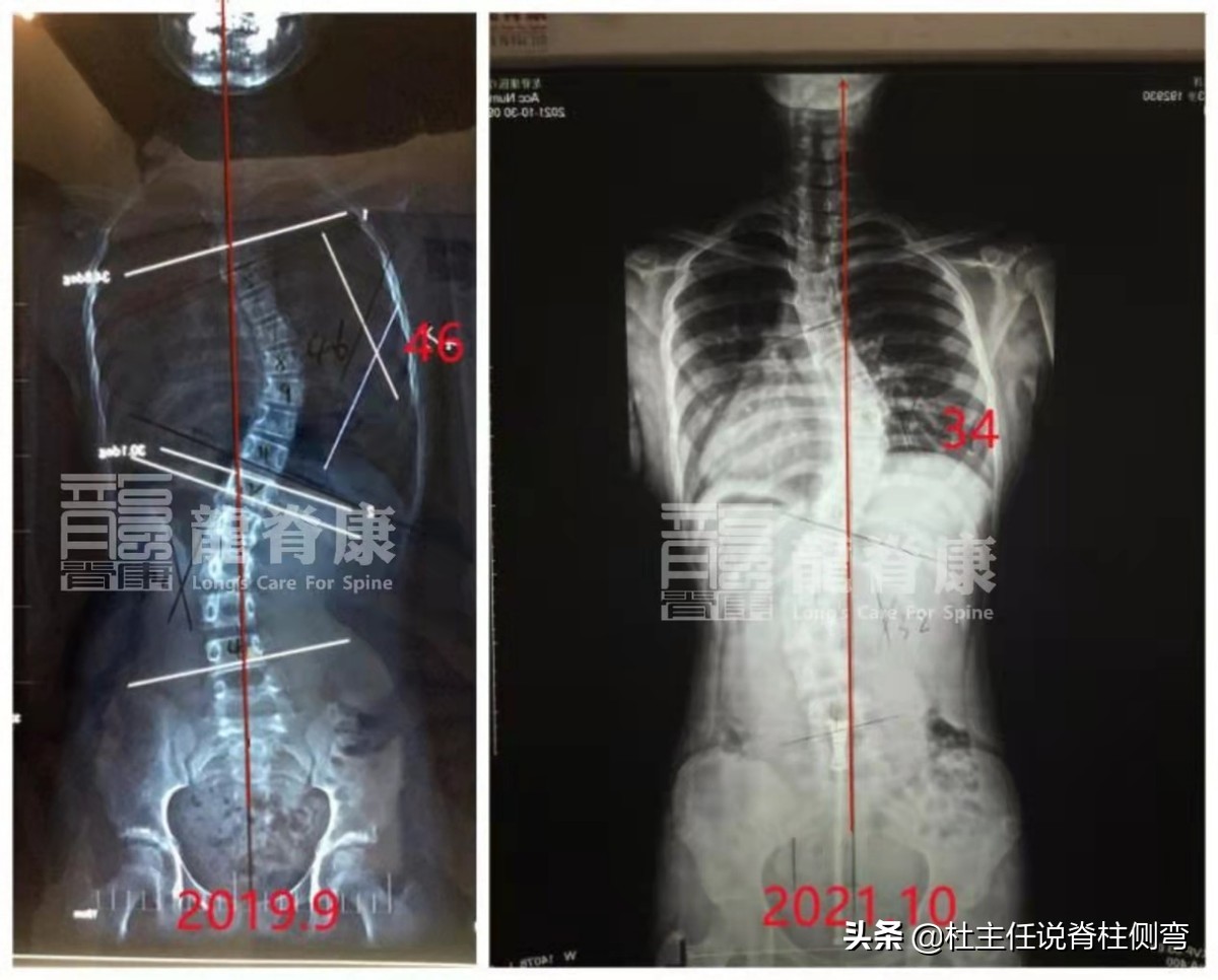 40多岁脊柱侧弯能戴矫正器吗,s弯脊柱侧弯40度要手术吗