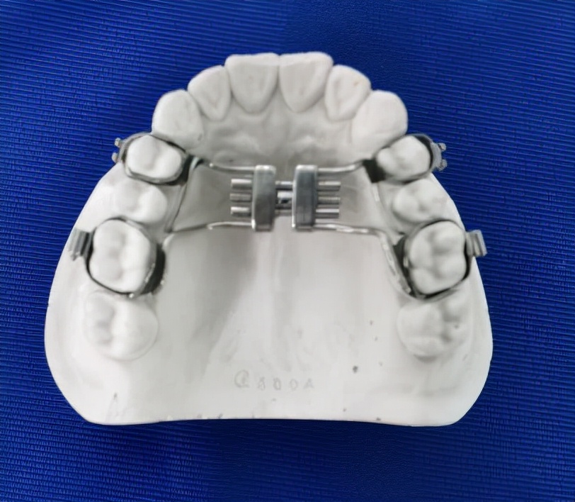 徐州儿童牙齿矫正牙齿不齐,大连口腔医院儿童牙齿矫正怎么样