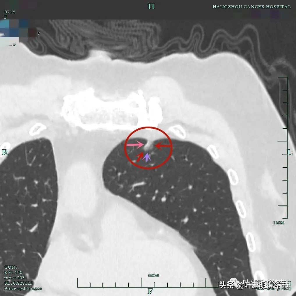 右下叶磨玻璃6mm结节基本上是癌,右下叶少许炎症上叶磨玻璃结节