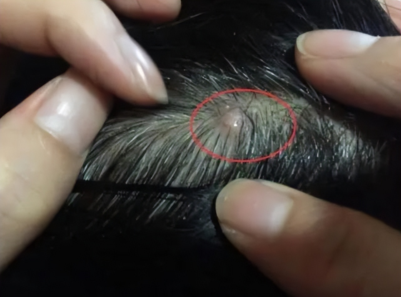 头皮上总是长疙瘩脓包是怎么回事,头皮上经常有疙瘩和脓包怎么回事