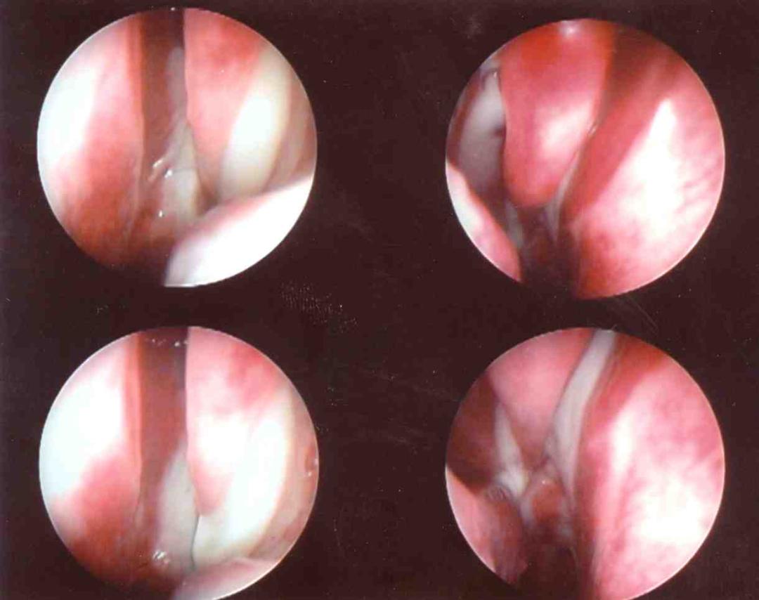 宝璋医院|感冒还是鼻窦炎？傻傻分不清楚？