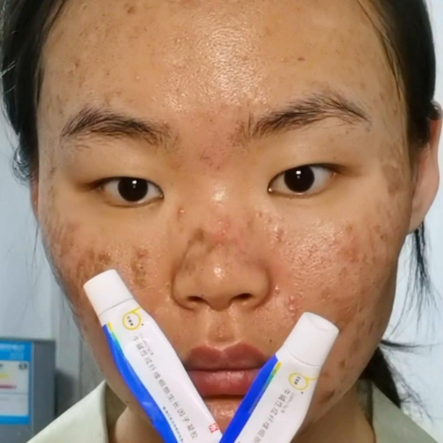 点阵激光后日常护理,点阵激光术后喷雾推荐