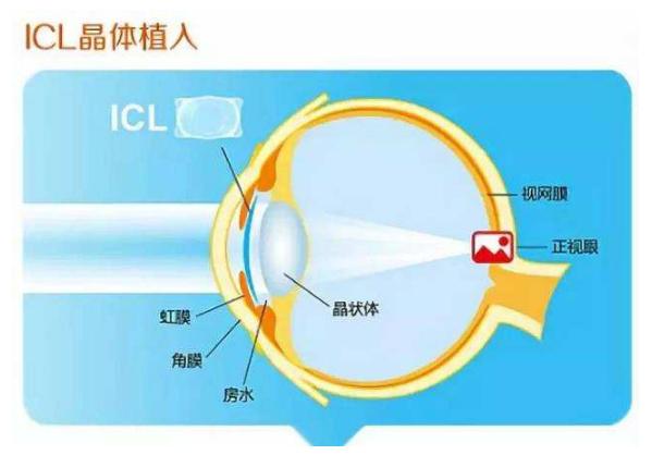 超高度近视怎么办,超高度近视怎样预防视力下降