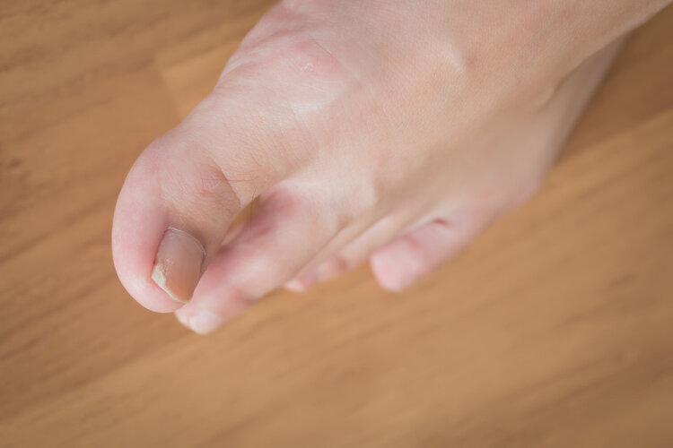 脚趾甲长到肉里一碰就疼如何解决,脚趾甲老是往肉里长怎么办