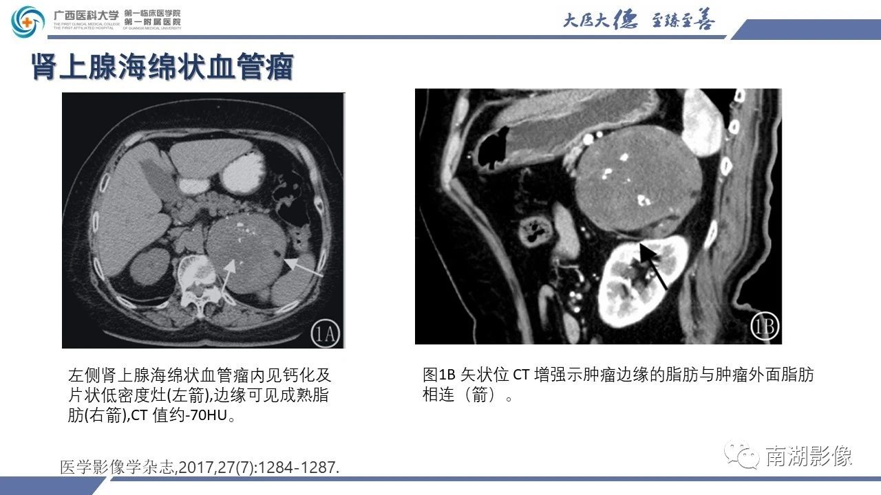 肾上腺海绵状血管瘤,肾上腺血管瘤是良性还是恶性