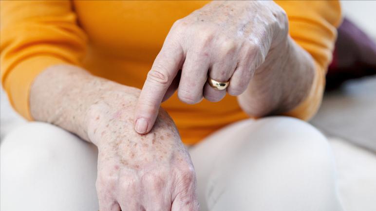 快速消除老年斑的小妙招红霉素,红霉素软膏对老年斑有治疗作用吗