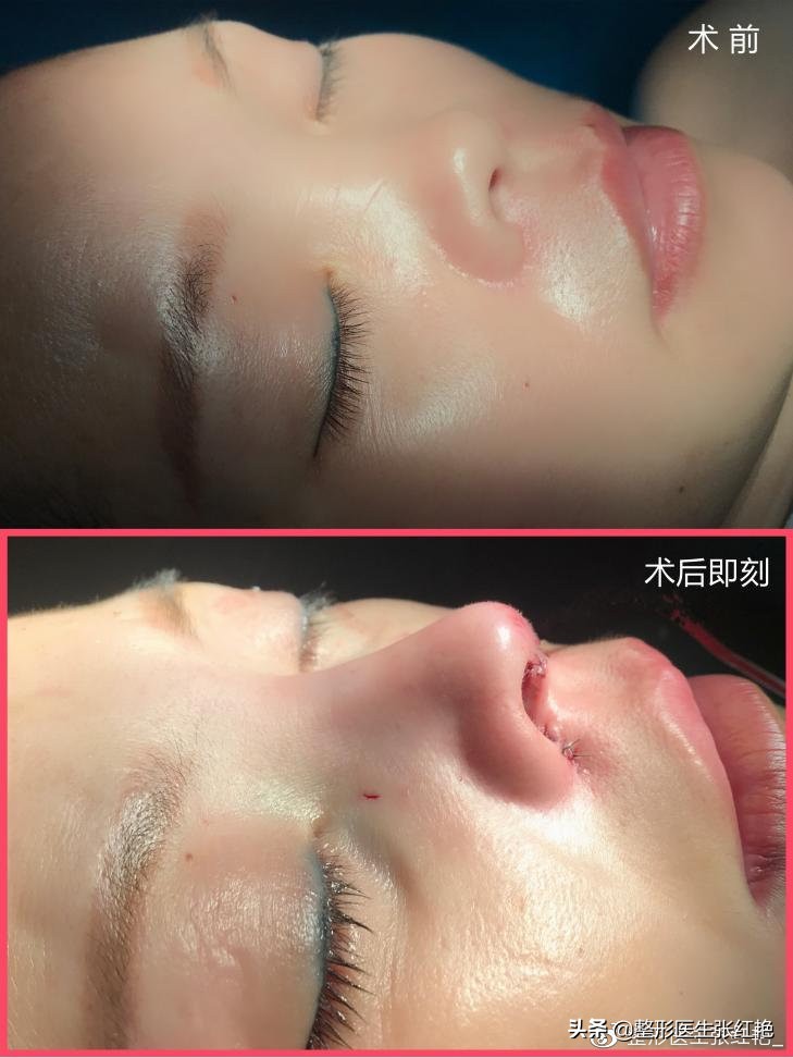 塌鼻头大鼻头怎么修容,塌鼻子和大鼻头如何变高挺