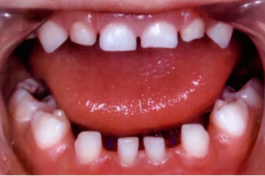 宝宝牙缝大是吃糖引起的吗,宝宝牙缝太宽了吧