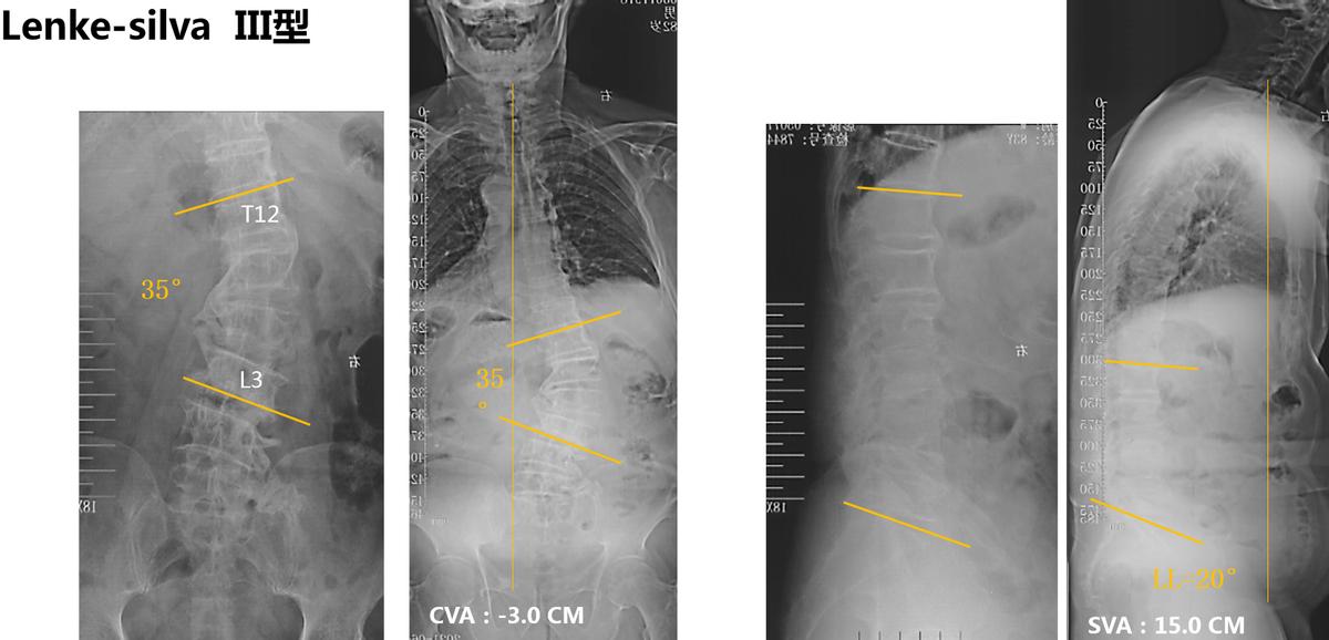老年人脊柱侧弯的危害和症状,老人脊柱侧弯腰部疼痛怎么缓解