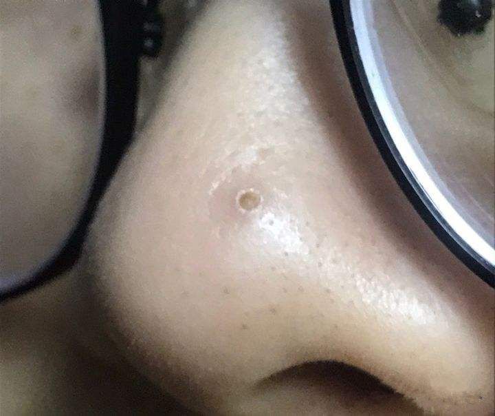 为什么鼻子可以挤出很大的黑头,用夹子挤出鼻子黑头