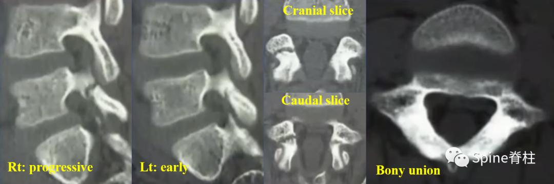 峡部裂和隐性峡部裂有区别吗,单纯峡部裂可以做峡部修复吗