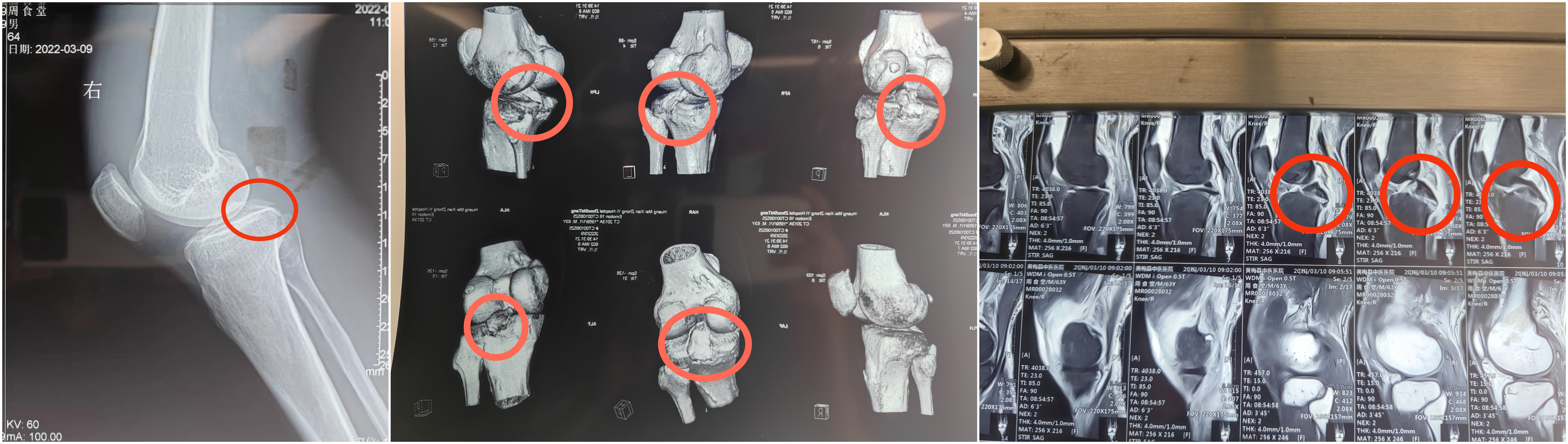 骨伤微创手术,黄梅县中医医院骨伤一科