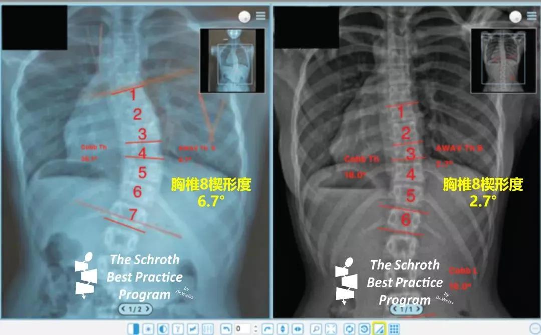 脊柱侧弯可以矫正过来吗,脊柱侧弯可以通过松解筋膜矫正吗