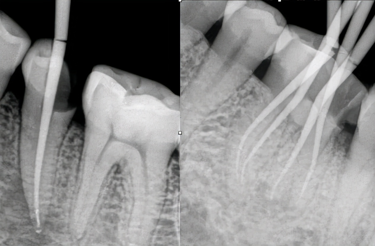 牙根尖炎治愈后要不要做牙套,牙根尖炎一般多久可以康复
